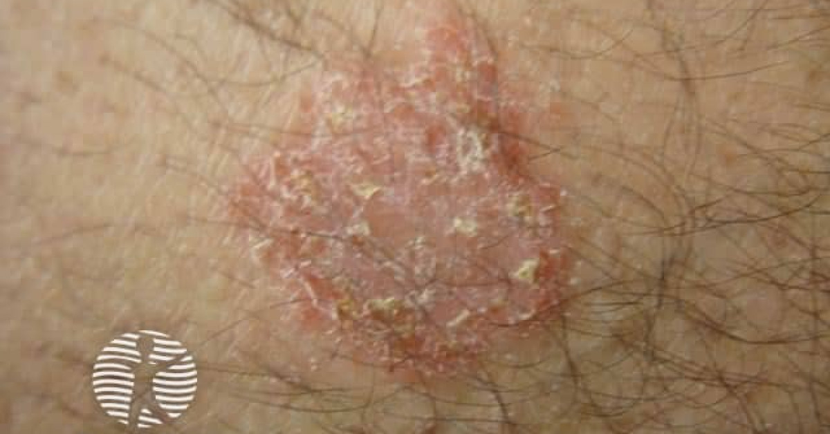 DermNet® - Nummular dermatitis discoid eczema image