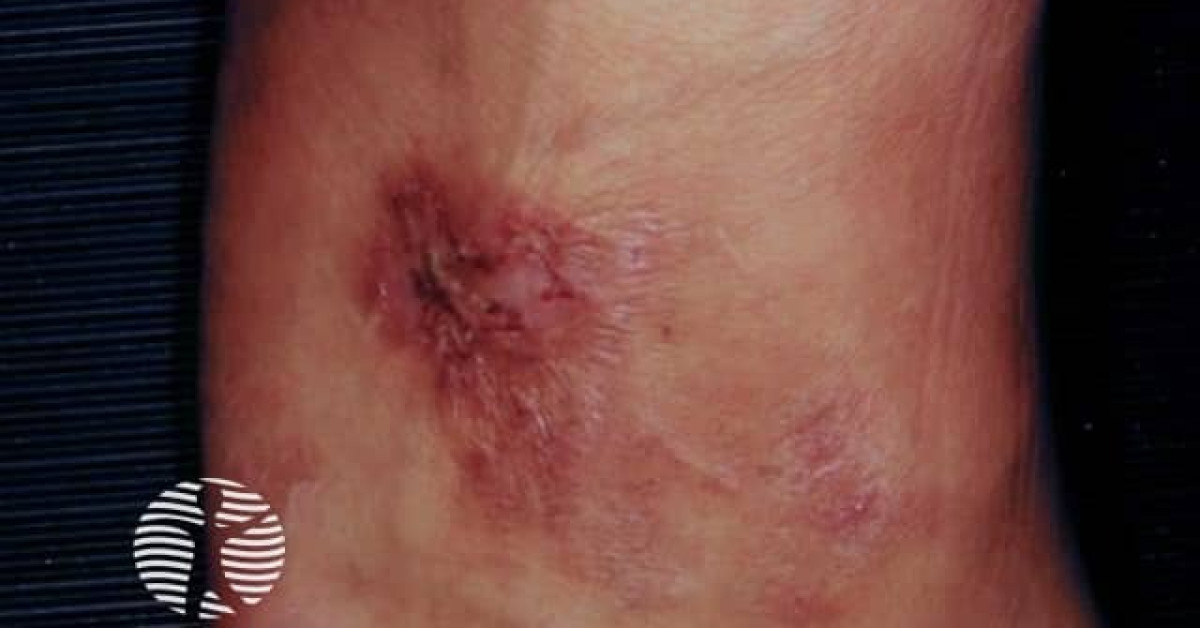 Nummular dermatitis discoid eczema image