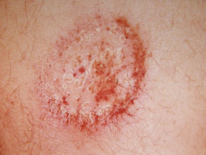 Nummular dermatitis discoid eczema