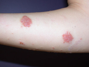 Nummular dermatitis discoid eczema