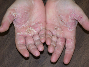 atopic dermatitis palms