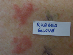 Patch tests positive to rubber gloves