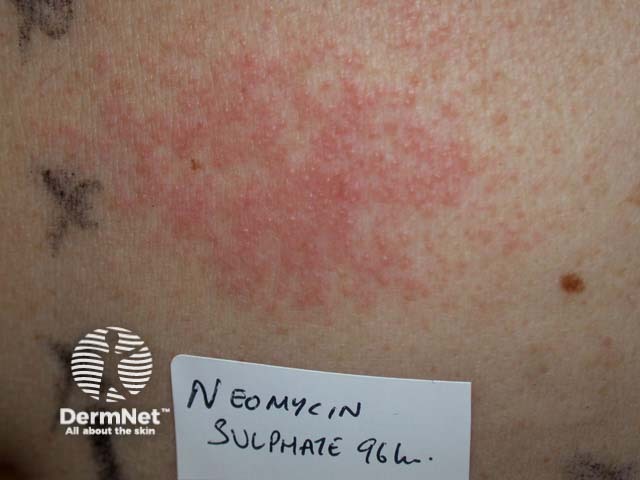  Patch test ++ reaction to neomycin