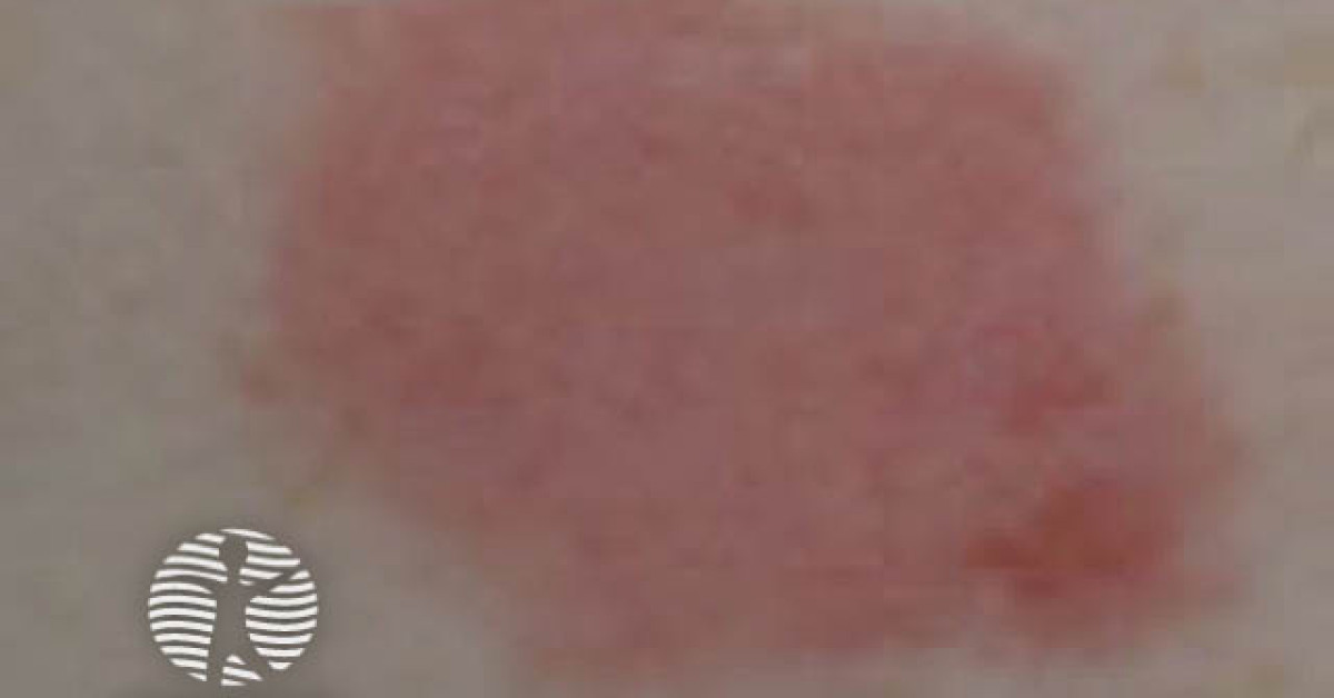 Positive patch test to 4tertButylphenol formaldehyde resin image