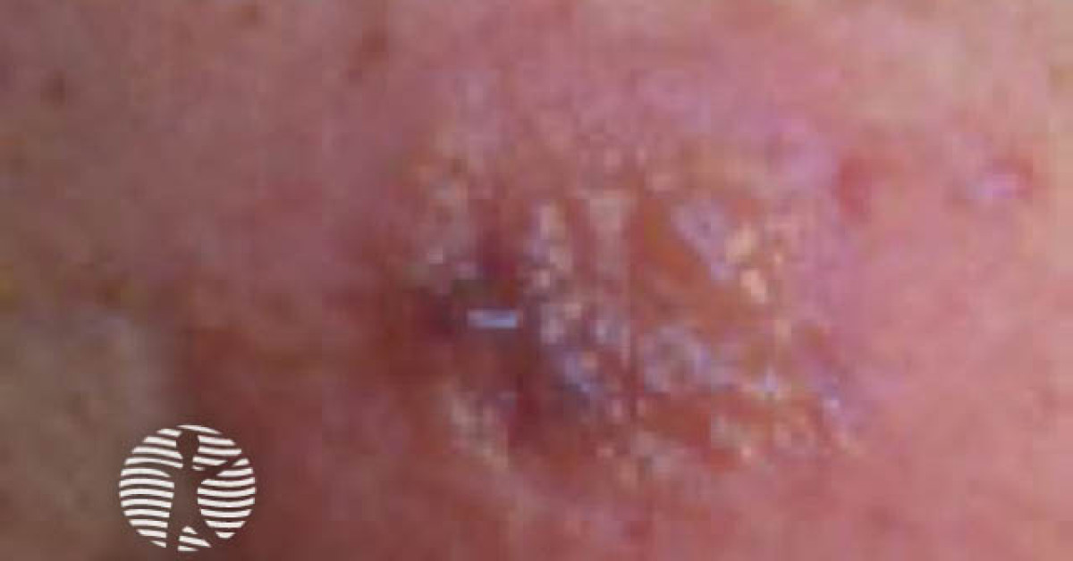 Positive Edelman Test Positive patch test to ethylenediamine image