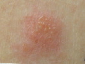 Positive patch test to sodium thiosulfate (gold)