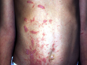 grevillea dermatitis