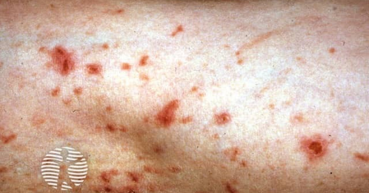 String trimmers dermatitis image