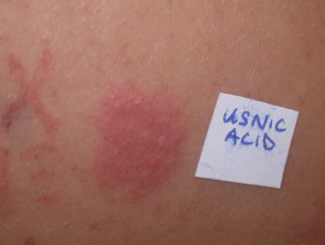 Patch test allergy to usnic acid