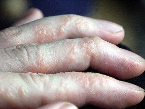 Vesicular Hand Dermatitis Dermnet Nz