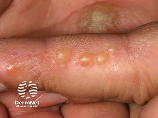 Dyshidrotic Eczema Fingertips Dyshidrotic Eczema Fingertips