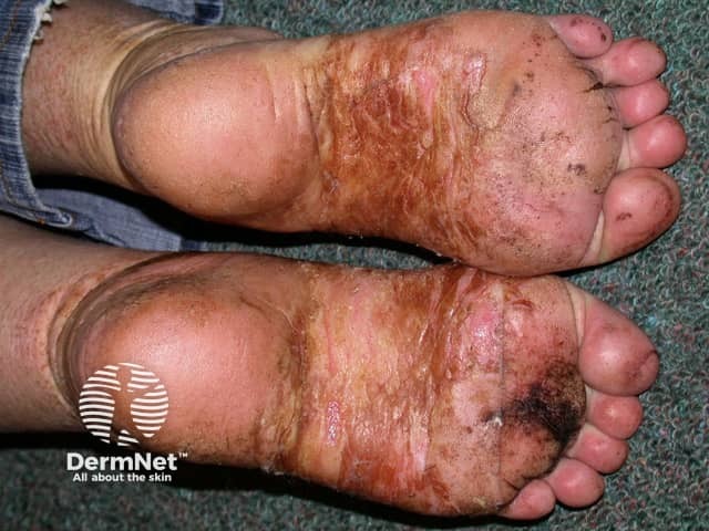 Extensive vesticulation and blistering on the soles - vesicular eczema is usually symmetrical
