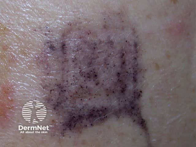 Black skin staining due to the hair dye allergen PPD