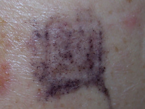 Patch test skin