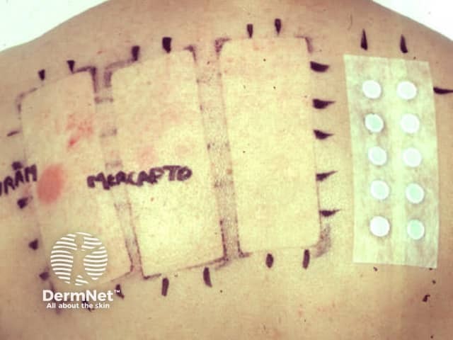 Patch test removal at 48 hrs with positive reaction to a rubber accelerator