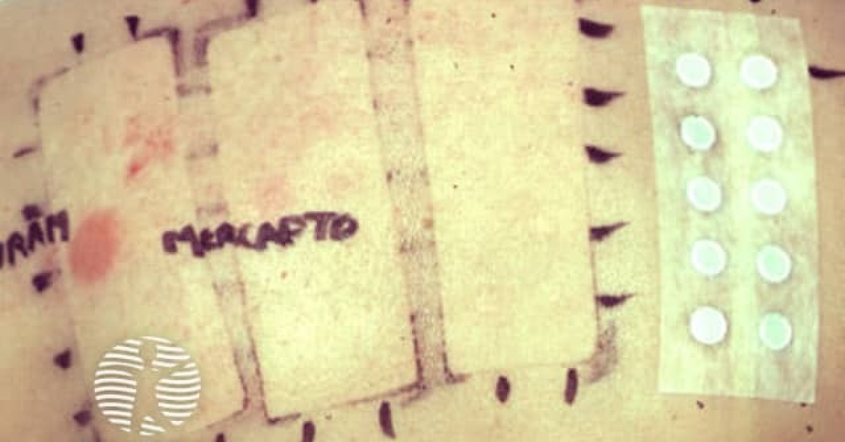 Patch tests image
