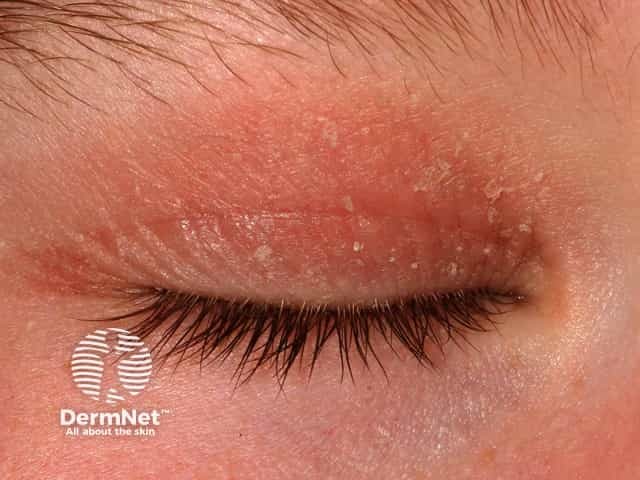 Atopic dermatitis of the eyelid