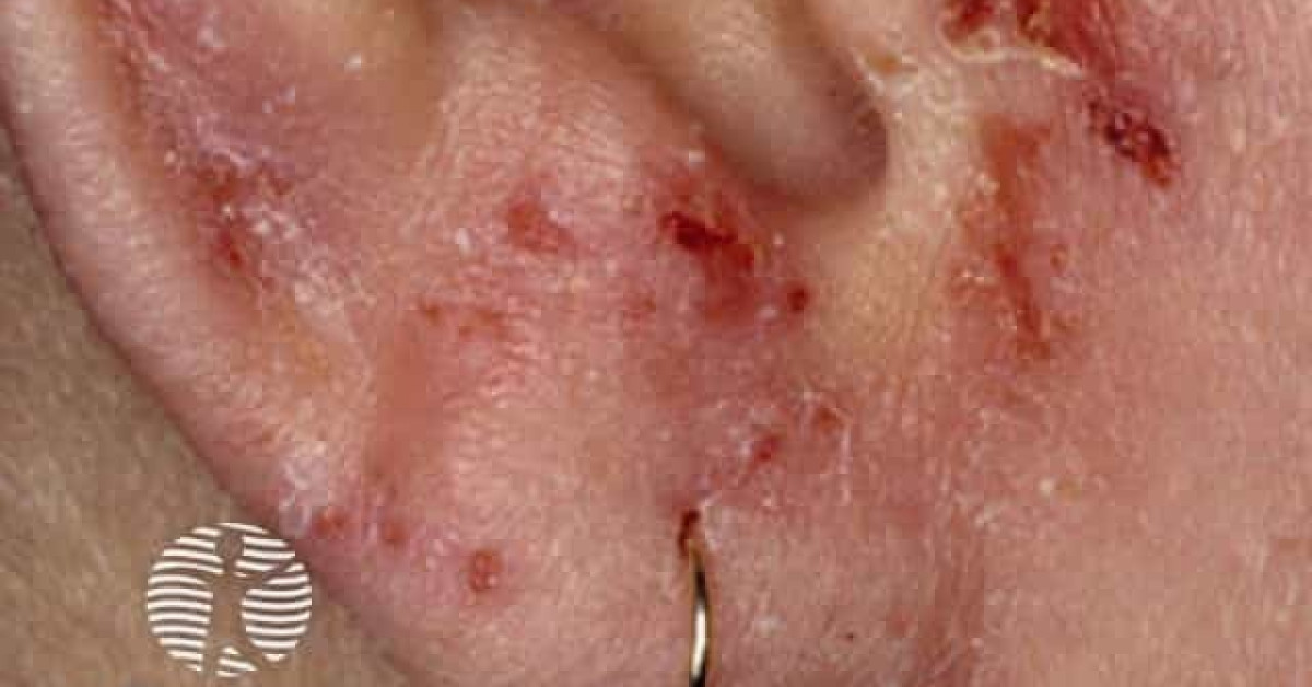 Atopic dermatitis image