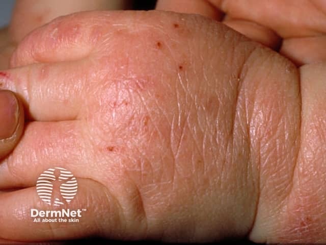 Infantile atopic dermatitis, hand