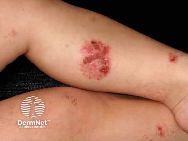 Infected nummular atopic dermatitis