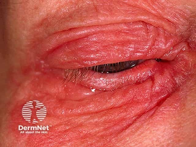 Severe acute eyelid dermatitis