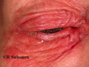 Eyelid contact dermatitis