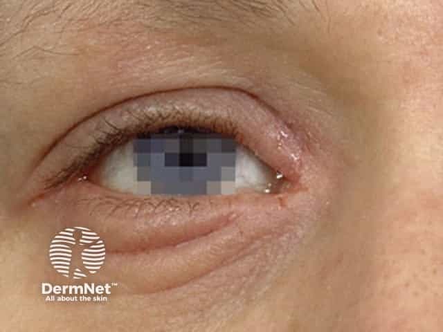 Eyelid contact dermatitis