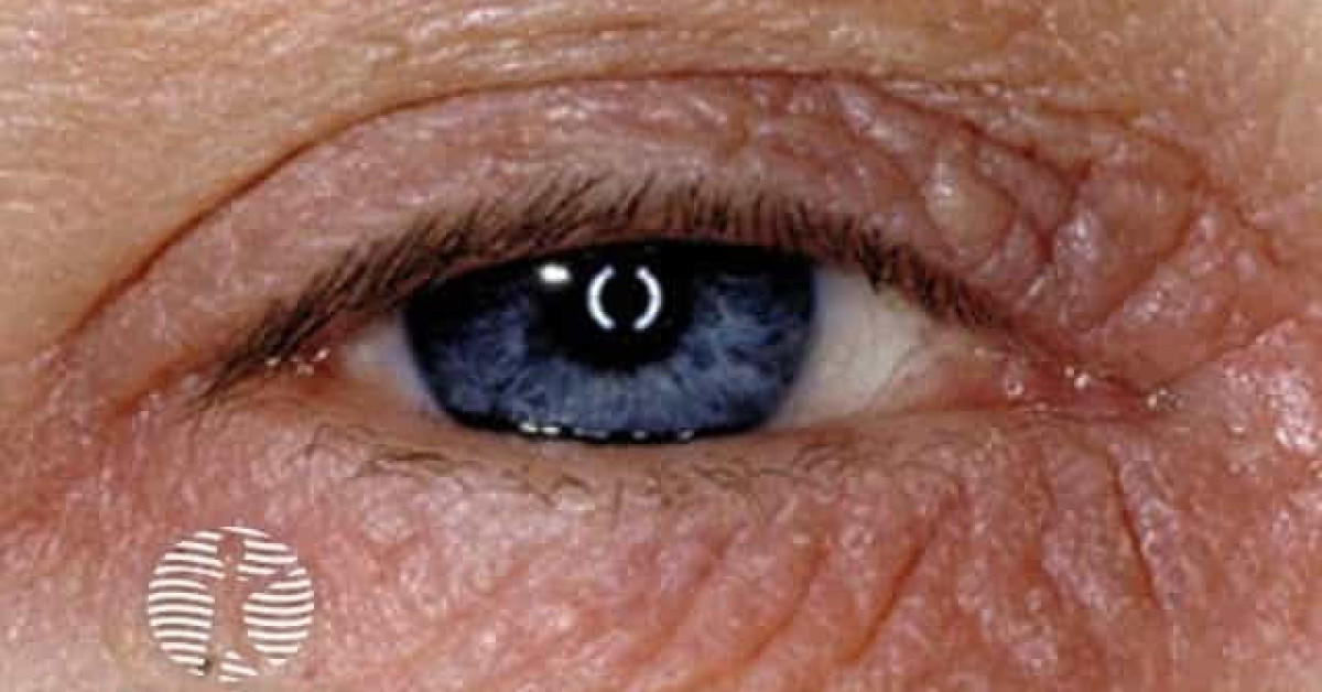 Eyelid Contact Dermatitis Image