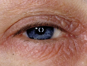 Eyelid Dermatitis Images Dermnet Nz