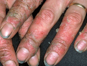 Irritant dermatitis