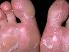 cracks between toes