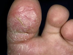 split skin on soles of feet
