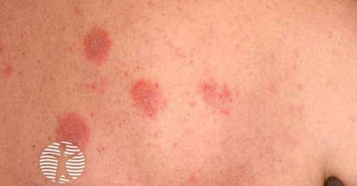 Nummular Dermatitis Discoid Eczema Image