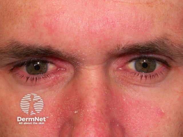 Seborrhoeic blepharitis and dermatitis on the cheeks