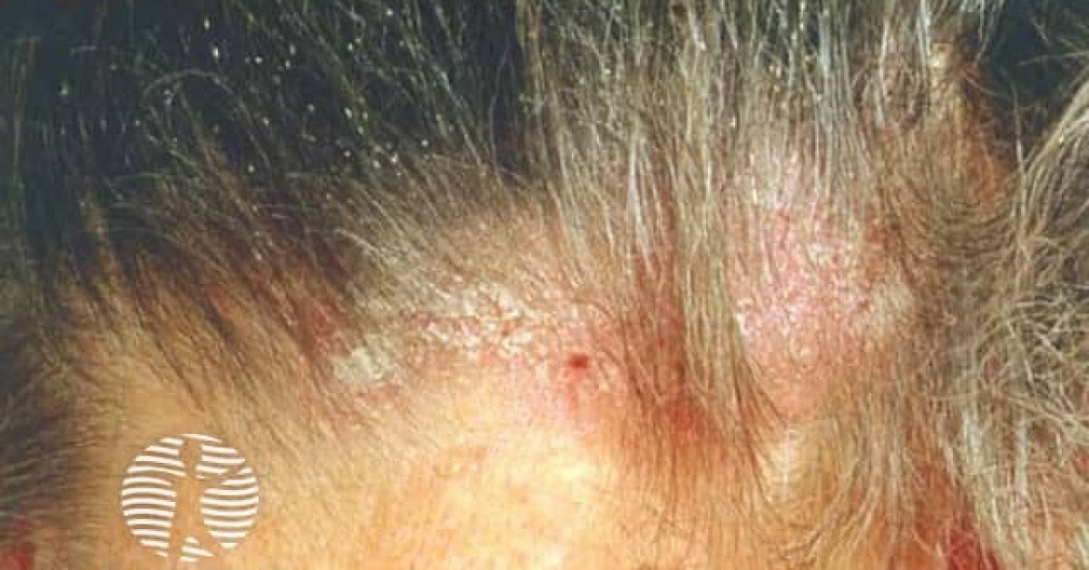 Seborrhoeic dermatitis image