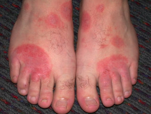 Shoe dermatitis