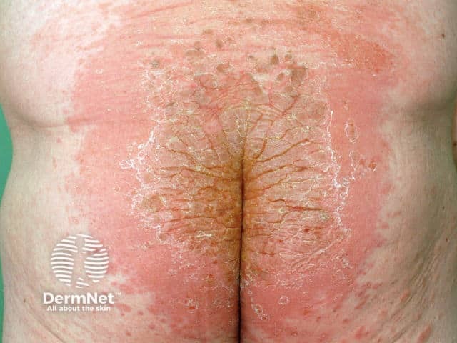 Allergy to dimethyl fumarate: sofa dermatitis