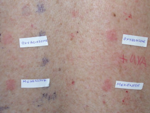 Oxybenzone and mexenone allergy on patch testing with photoaggravation