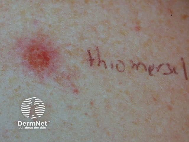 Positive patch test to thiomersal