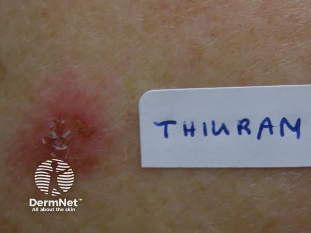 Positive patch test to thiuram, rubber antioxidant