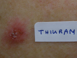 Patch test positive to thiuram