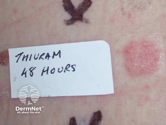 Positive patch test to thiuram