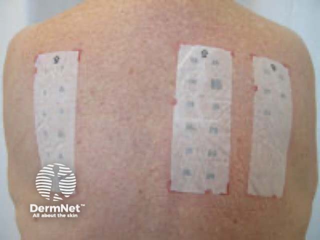 Baseline series of patch test allergens | DermNet New Zealand