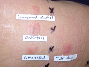 Patch tests in cosmetic allergy