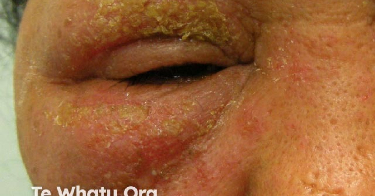 Contact allergy to hair dye image