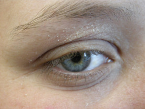 eczema eyelids