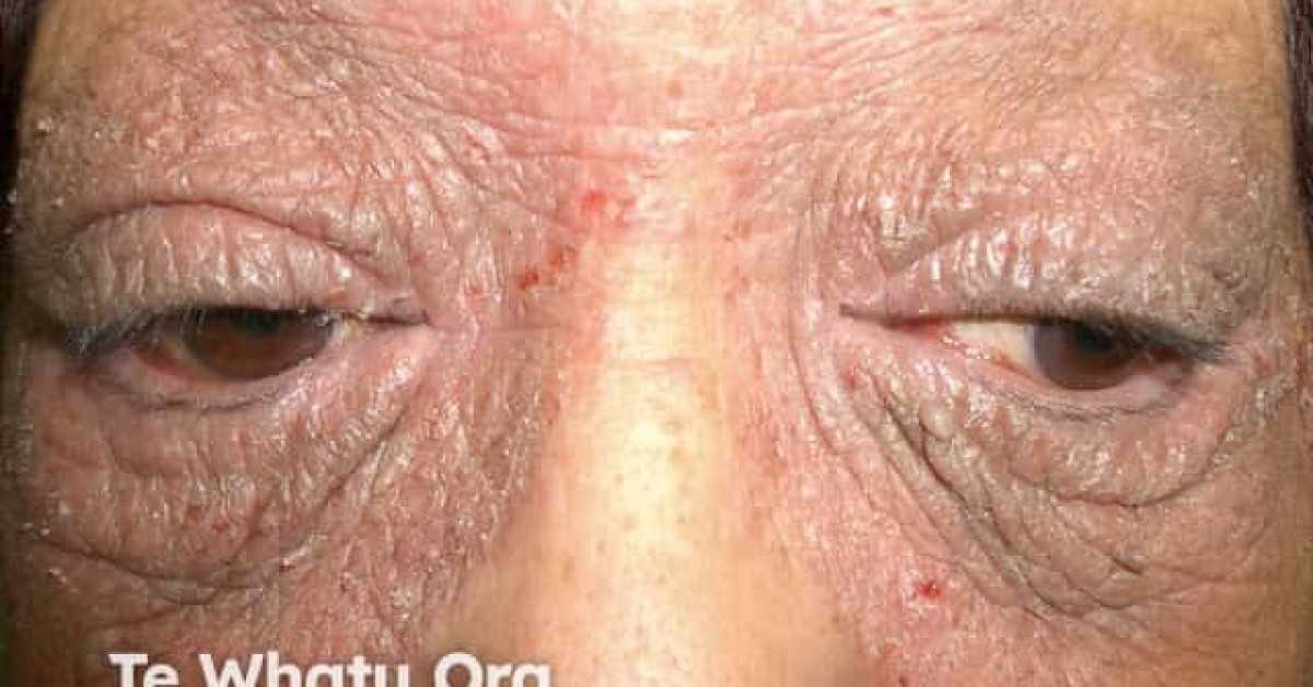 how to get rid of eyelid contact dermatitis