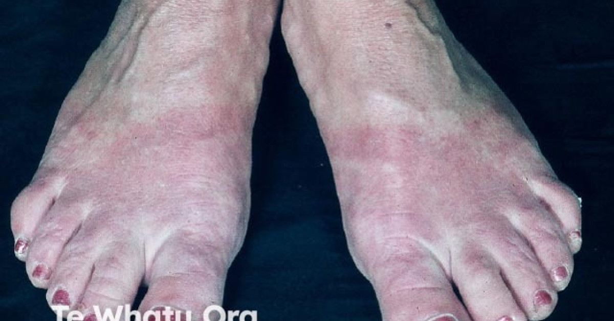 Shoe dermatitis image