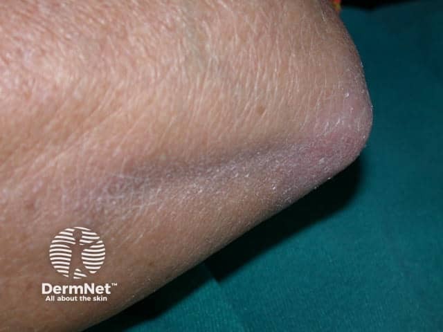 Dermatomyositis of the arm