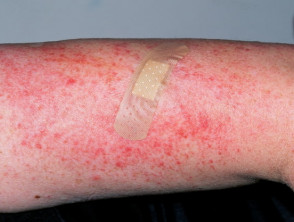 Dermatomyositis of the arm 